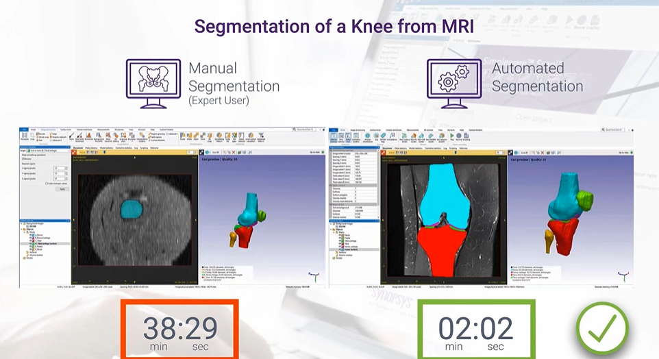 Knee MRI segmentation